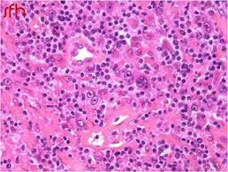 Classifications histopathologiques