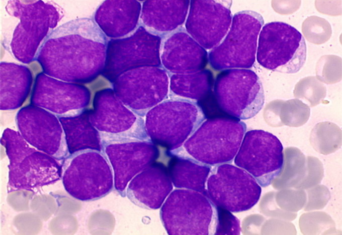 Les lymphomes lymphoblastiques: Spécificités cliniques...