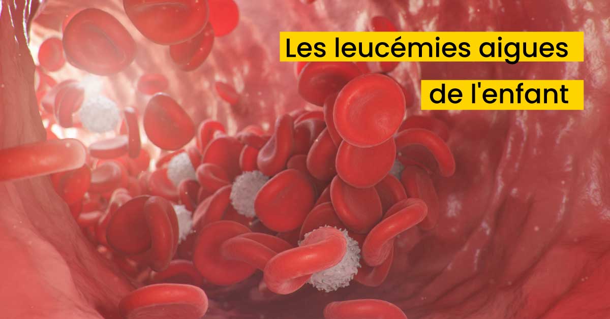 Les Leucémies aiguës lymphoblastiques