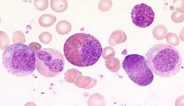 Les Leucémies aiguës Myeloblastiques