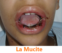 La Mucite